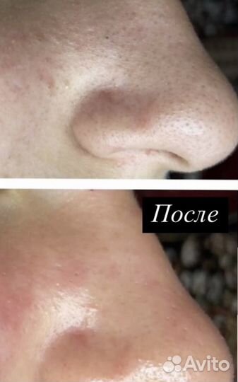 Косметолог чистка лица