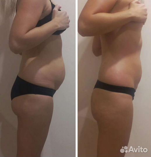 Аппаратная коррекция фигуры