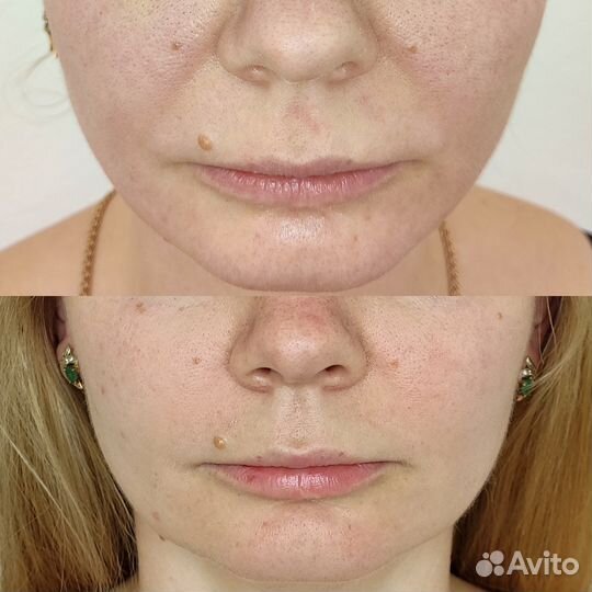 RF-лифтинг (подтяжка)