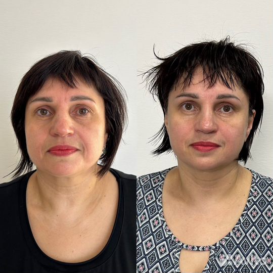 Массаж лица