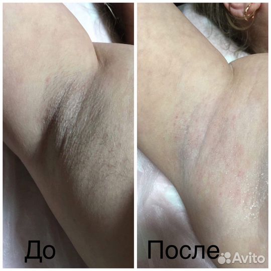 Депиляция воском