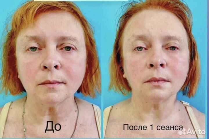 Мадеротерапия Лица