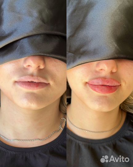 Увеличение губ