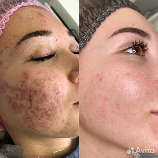 Обучение акне / постакне / коррекция рубцов