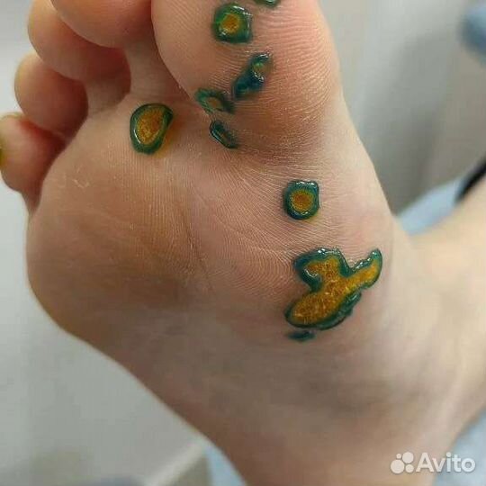 Медицинский педикюр подолог