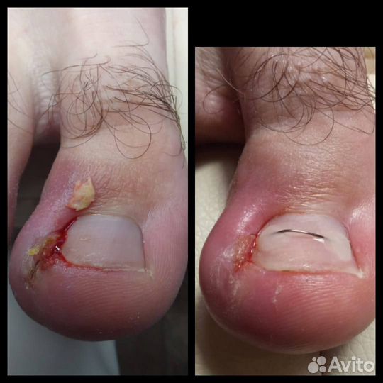 Подолог, лечебный педикюр