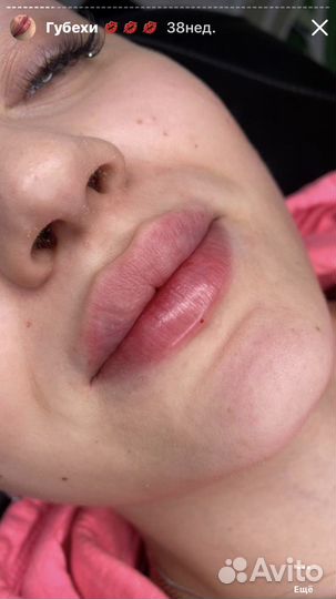 Увеличение губ