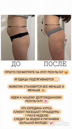 Криолиполиз/Массаж/Косметолог/Миостимуляция