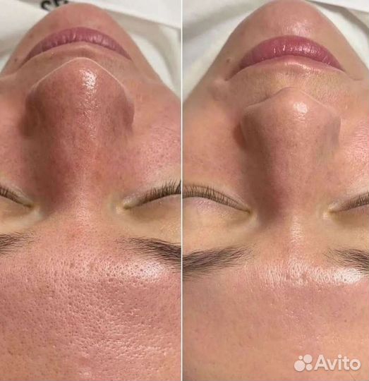 Увеличение губ