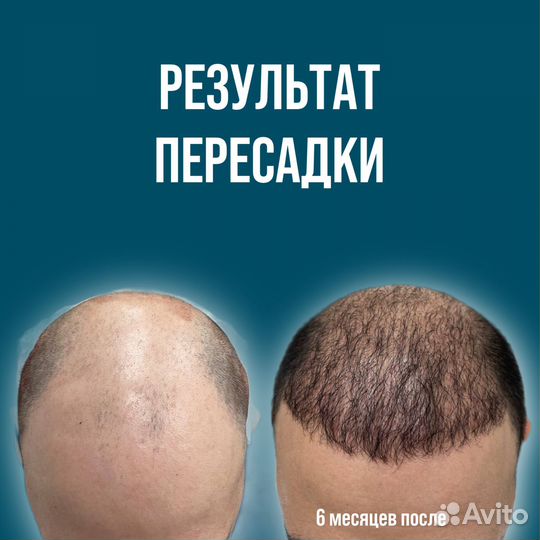 Лечение облысения навсегда