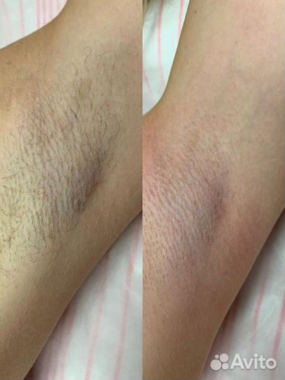 Шугаринг/ Восковая депиляция