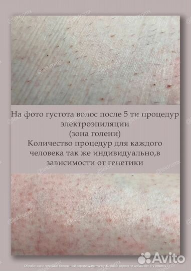 Электроэпиляция