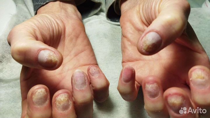 Педикюр подолог