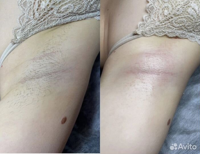 Шугаринг/воск/депиляция