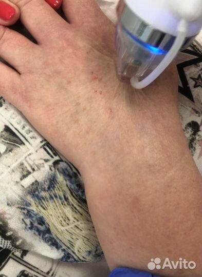 Микроигольчатый RF лифтинг лица