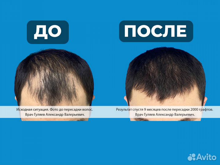 Пересадка волос для мужчин