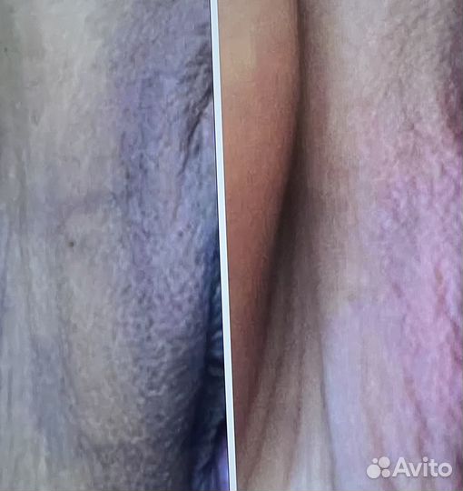 Интимное омоложение