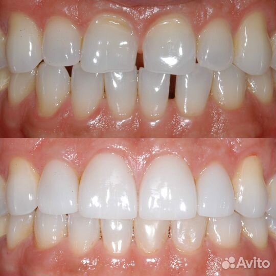 Керамические конструкции IPS е.мах