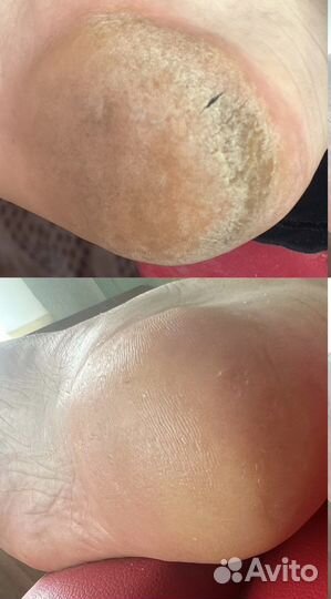 Подолог с выездом на дом