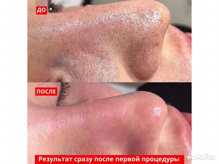 Чистка лица пилинг косметолог акне