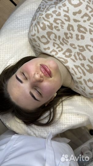 Вкусные губы корекция увеличение пластика губ