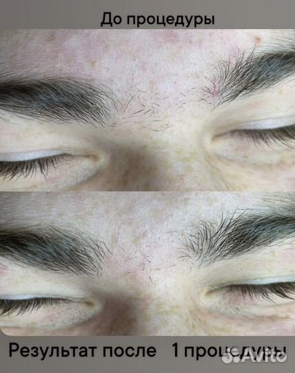 Мастер электроэпиляции