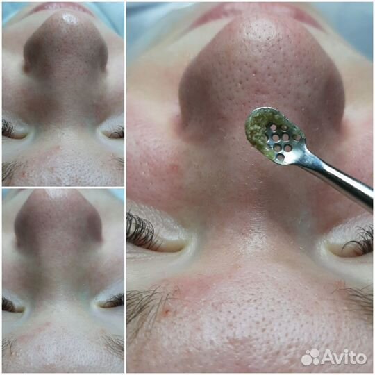 Косметолог Чистка лица