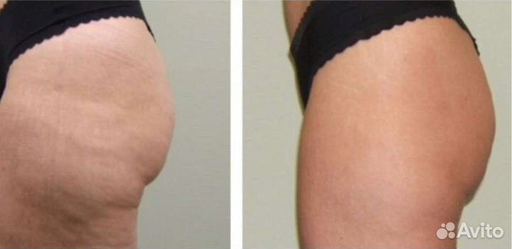 Подтяжка кожи на теле и руках
