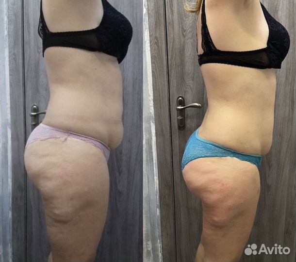 Антицеллюлитный массаж с эффектом сразу