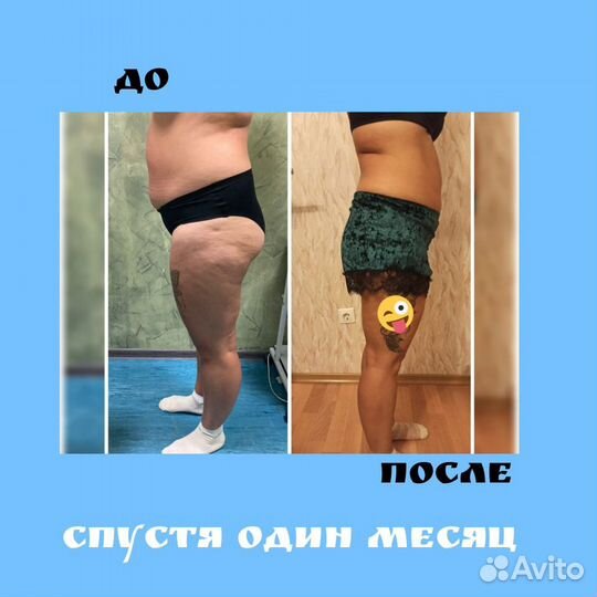 Криолиполиз услуги