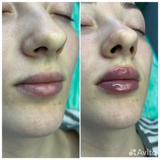 Модель на увеличение губ