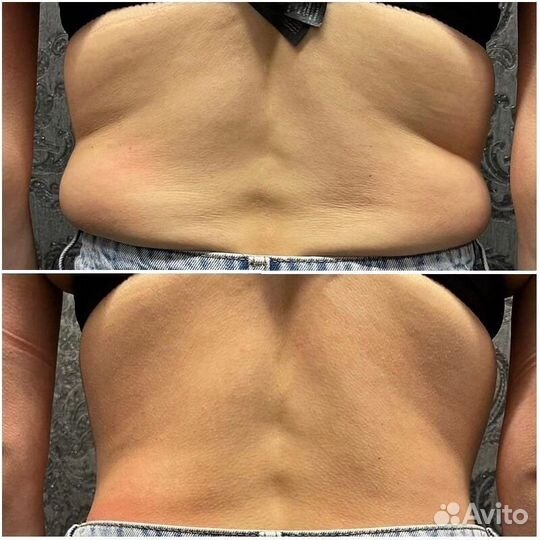 Аппаратный массаж. Коррекция, похудение