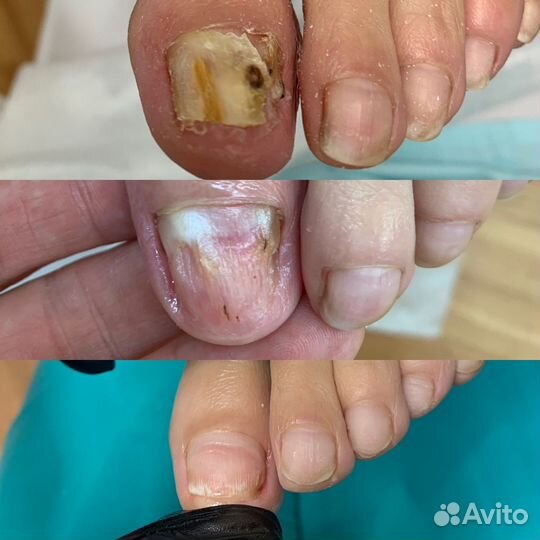 Медицинский педикюр, подолог