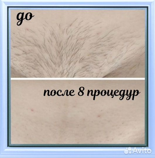 Электроэпиляция