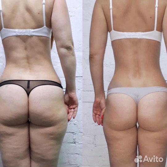 Антицеллюлитный массаж