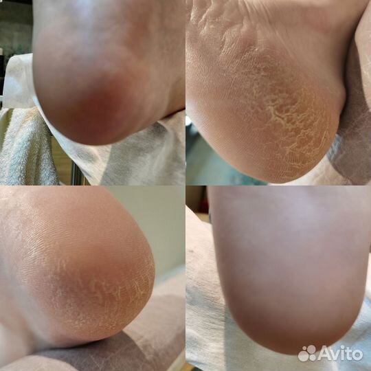 Smart-Педикюр