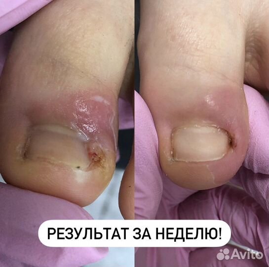 Подолог.Медицинский педикюр.Титановая нить