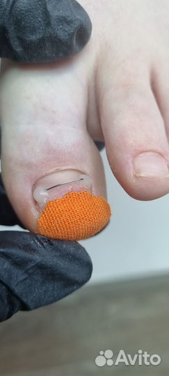 Восстановление ногтей