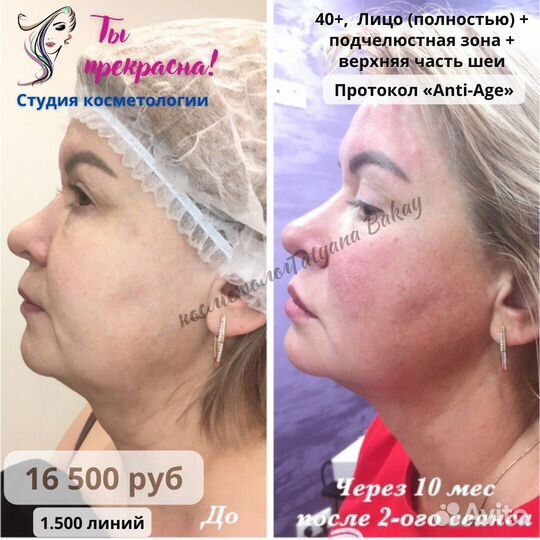 СМАС лифтинг подтяжка лица/ Омоложение/ Косметолог