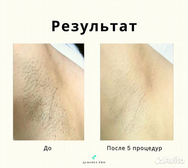 Диодный лазер для эпиляции Люминес Макс’Ван 1200