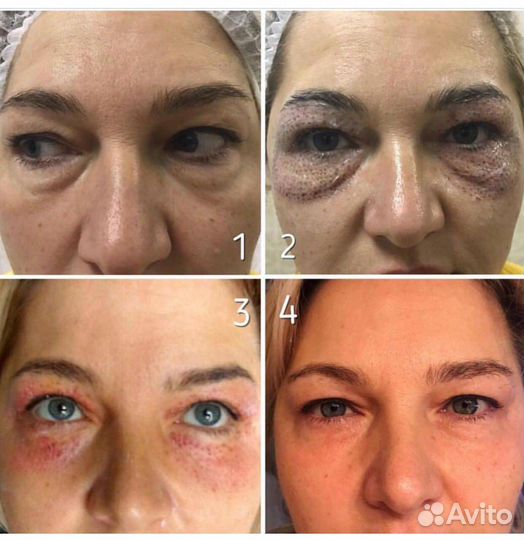 Дарсонвализация