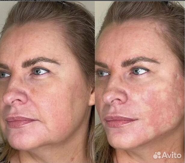 Подтяжка лица за 1 процедуру. СМАС лифтинг