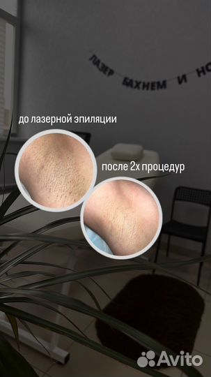 Лазерная эпиляция