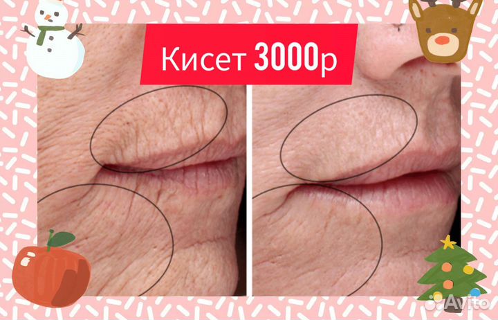 Модели ботокс, диспорт, от морщин, мимики, био