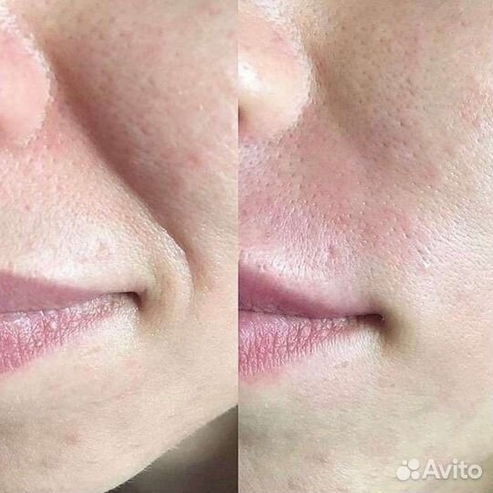 Коррекция носогубных морщин