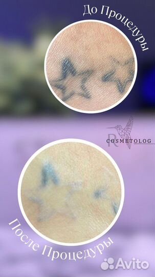 Модели на лазерное удаление Тату и перманента