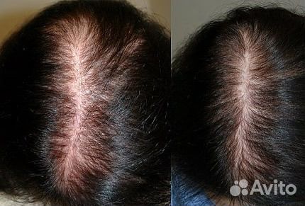 Коктель Монако Мезотерапия биоревитализация пилинг