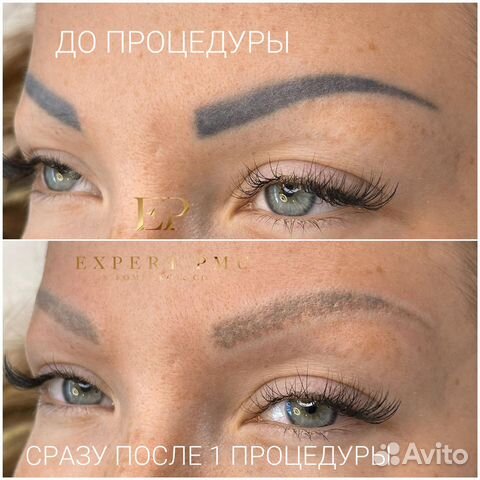 Удаление Тату и Татуажа