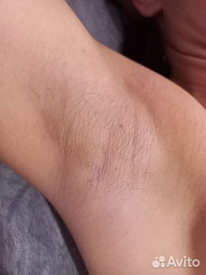 Лазерная эпиляция