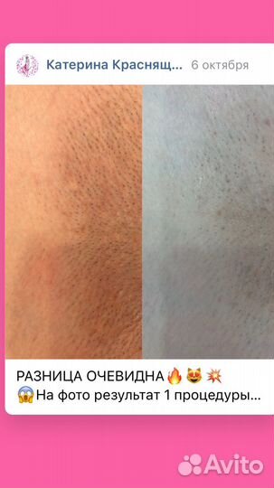 Лазерная эпиляция